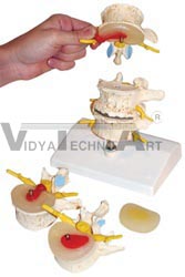 Stages of disc prolapse and lumbar vertebral degeneration